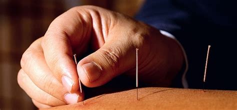 what do i need to know about acupuncture prp survival guide