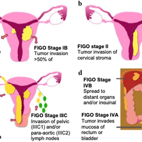 Illustrated Figo Staging System For Endometrial Cancer A Stage 1