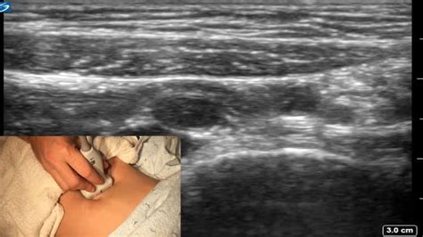 Adam S Appendicitis How To Ultrasound Ultrasound
