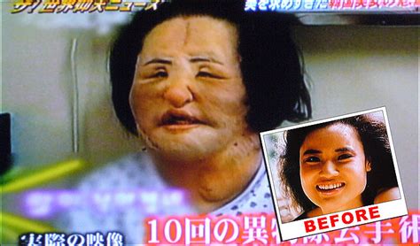 korean woman s face deformed after diy cooking oil injections