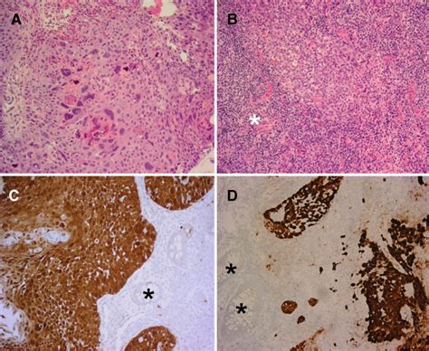 Synchronous Anal Canal Carcinoma In A Heterosexual Couple Bmc Cancer