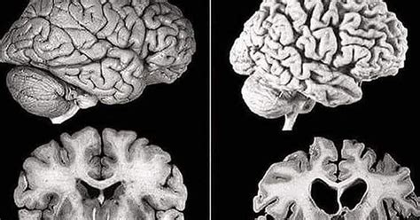 cuanta razon cerebro normal  cerebro  alzheimer
