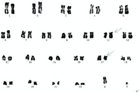 Karyotype Of Case C 46 Xy T 11 17 Q23 Q21 46 Xy Download High