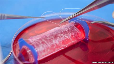 doctors implant lab grown vagina bbc news