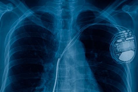 charging pacemaker breakthrough bhf