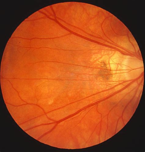impact  retinopathy  prematurity  ocular structures  visual