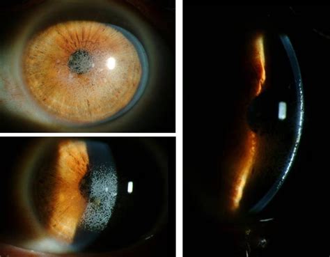 post lasik granular corneal dystrophy