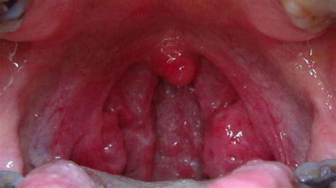 viral infection throat gue viral