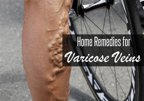 11 Home Remedies For Varicose Vein Get Rid Those Dark Lines On Your