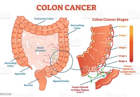 Colon Cancer Medical Vector Illustration Scheme Anatomical Diagram With