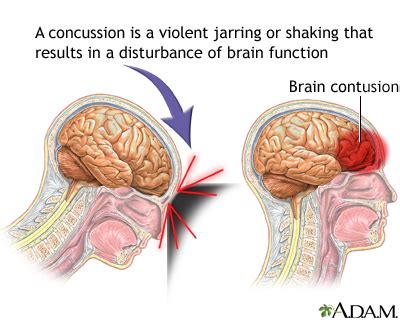 disease concussion