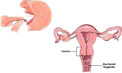 bacterial vaginitis home remedies causes symptoms