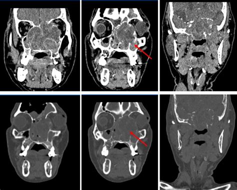 adenoid cystic carcinoma  ethmoidal sinus radiology cases