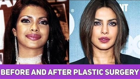 bollywood actresses    plastic surgery bollywood news