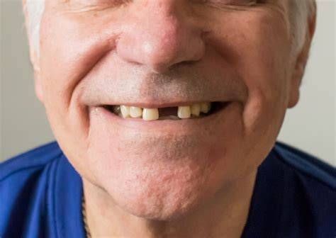 dental options  replacing missing teeth  federal