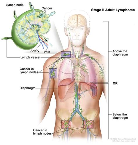 Lymphoma Cancer Dna Tumor Viruses And Human Cancer