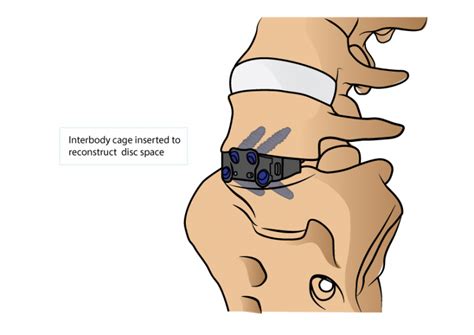 Minimally Invasive Anterior Lumbar Interbody Fusion Alif