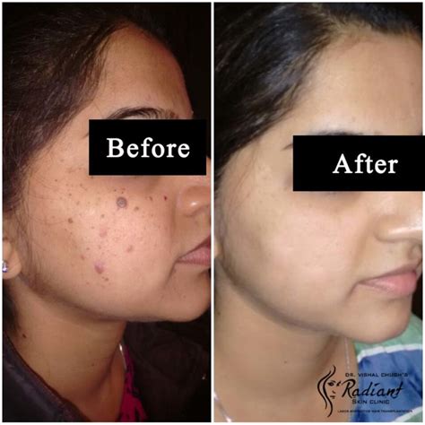 acne scar treatment i dr vishal chugh i radiant skin clinic