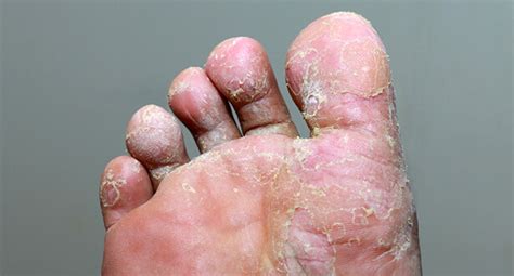 mycose des pieds ou pied dathlete traitement maison