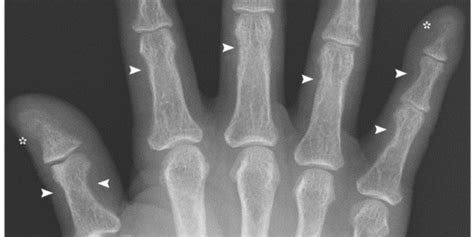 man s finger bones ‘eaten away due to hormonal condition huffpost