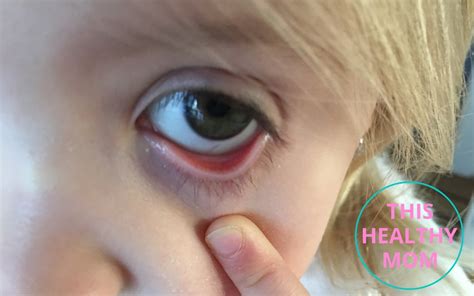 childs  eyelids     iron levels