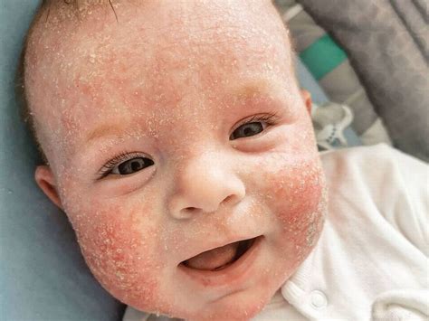 baby   milk allergy doctorvisit