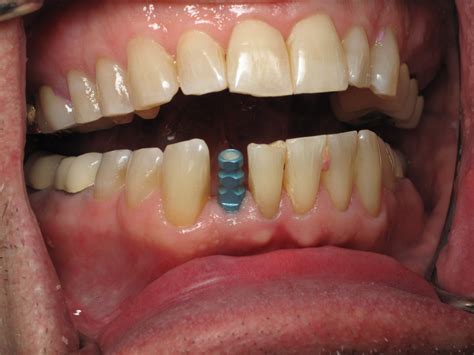 front tooth implants