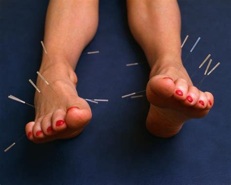 Acupuncture Soothes Plantar Fasciitis Pain Abba Anderson