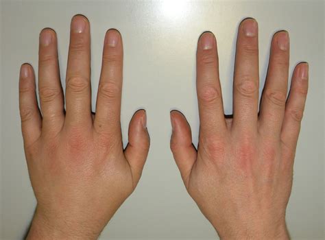dislocated  sprained finger volts