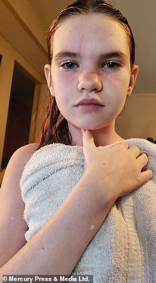 girl 12 is so allergic to water that having a shower could kill her