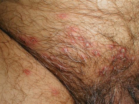 genital herpes sexually transmitted infection natural