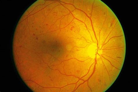 blindness due  diabetic retinopathy surges worldwide florida eye