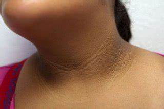 acanthosis nigricans pictures check  courses