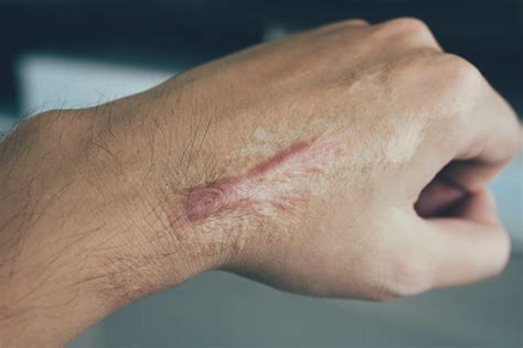 scars  mohs surgery      dermatology  skin