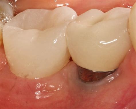 ceramic  titanium dental implants