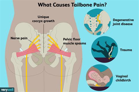 Tailbone Pain Causes Treatment And When To See A Doctor