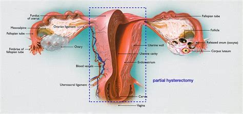 hysterectomy  center  innovative gyn care