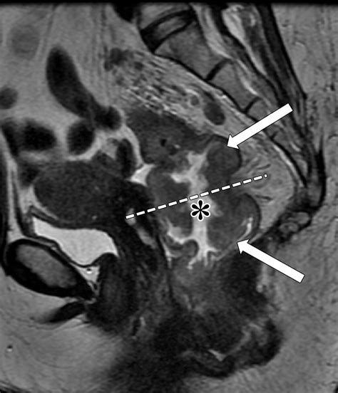Mri Of Rectal Cancer Tumor Staging Imaging Techniques And Management
