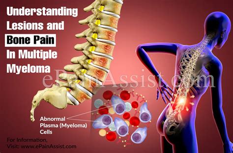 understanding lesions  bone pain  multiple myeloma