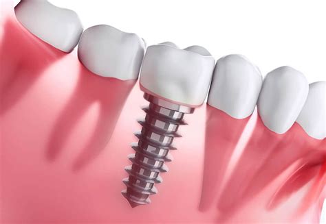 Implantes Dentários Tudo O Que Você Precisa Saber Dental Esthetic Center