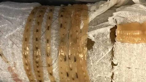 Five Foot Long Tapeworm Came Wiggling Out Of Man S Body After He Ate