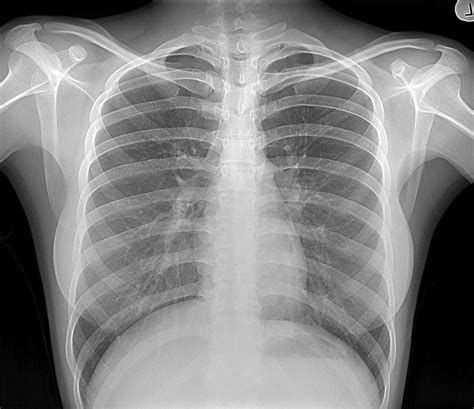 chest radiograph anatomybox part