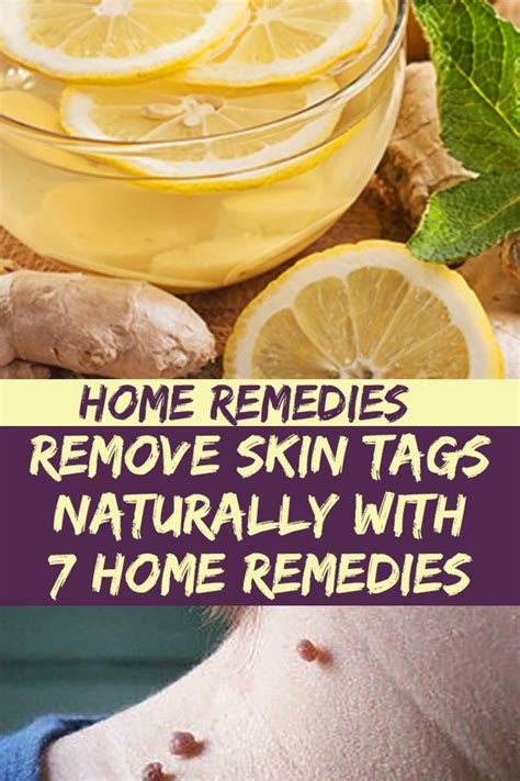 remove skin tags naturally with 7 home remedies all day share