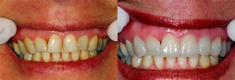 Before And After Dentist Manhasset Ny Golden Dental