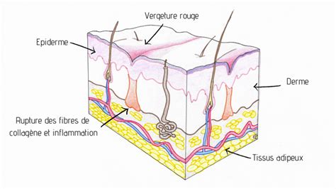 diminution des vergetures par la médecine esthétique dr