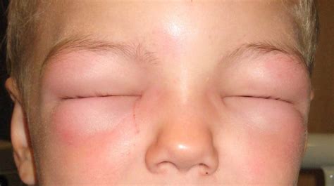 facial swelling  symptoms treatments