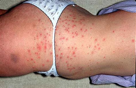 fоllісulіtіѕ hot tub rash infection causes symptoms treatment