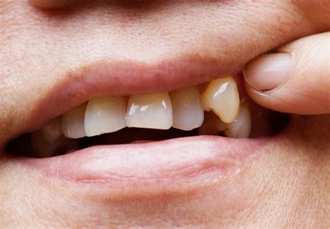 chipped teeth risks long island ny dental health  cosmetic problems