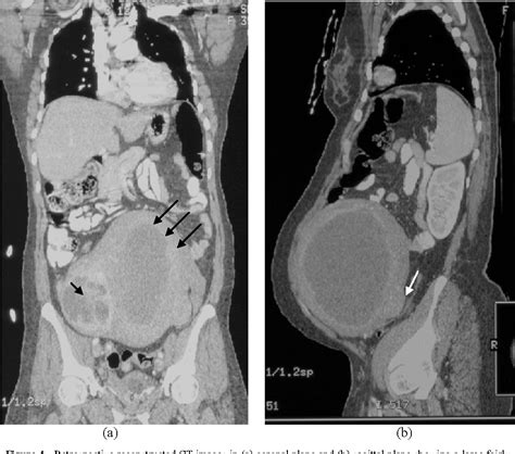 Biij Biomedical Imaging And Intervention Journal Degenerated Uterine