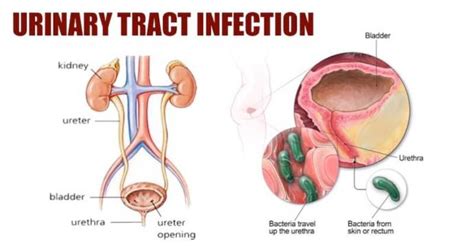 urinary tract infections uti symptoms risk factors